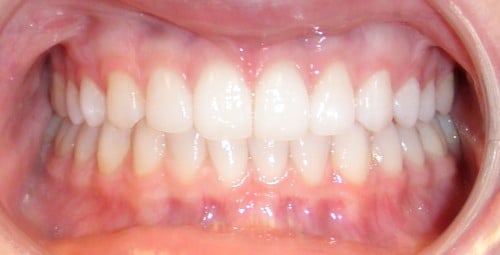 After photo: Patient with even spaced teeth in upper and lower jaws in Mento OH