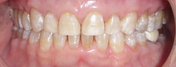 Before photo: Patient with stained teeth in Mento OH