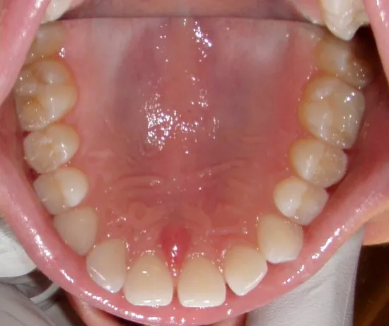 Before inside photo: Patient with gaps in upper jaw in Mento OH