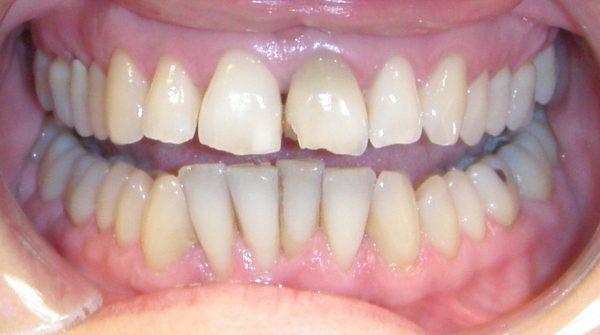 Before photo: Patient with damaged front upper and lower teeth due to trauma in Mento OH