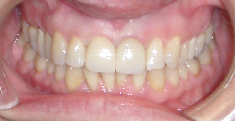 After photo: Patient with dental crowns and even, whiter teeth in Mento OH