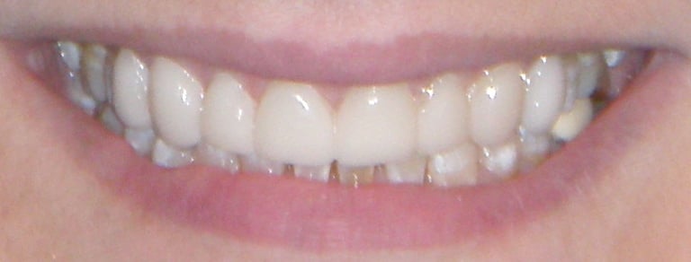 After photo: Patient with esthetic veneers and a whiter smile in Mento OH