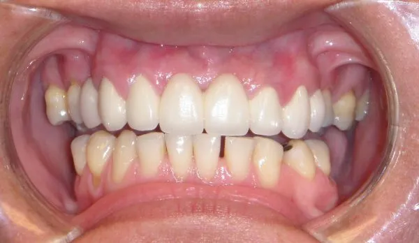 After Photo: Patient with Dental Bridge and crowns and even upper teeth in Mento OH