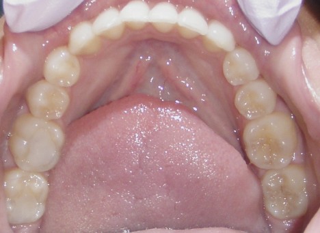 After inside photo: Patient with no crowding of lower jaw teeth in Mento OH