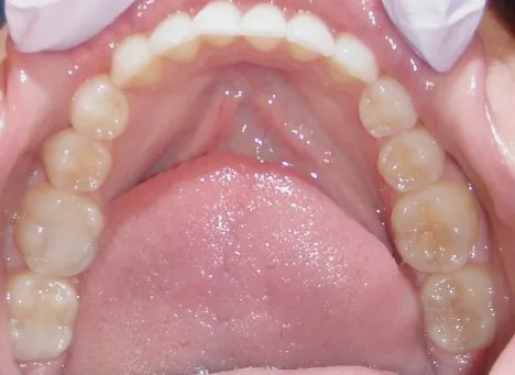 After inside photo: Patient with no crowding of lower jaw teeth in Mento OH