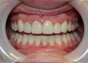 After photo: Patient mouth with whitened teeth of even size and shape in Mento OH