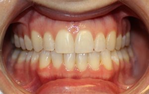 After photo: Teeth and bite straightened after Invisalign treatment in Mento OH