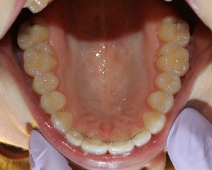 After photo: Evenly spaced upper teeth after Invisalign in Mento OH