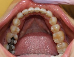 After photo: evenly spaced and aligned lower teeth after Invisalign in Mento OH