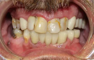 Before photo: Patient mouth with severely decayed teeth in Mento OH