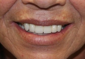 Before photo: Failing Upper Teeth in Mento OH