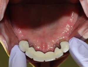 Before Photo (inside the mouth view): Failing Upper Teeth in Mento OH