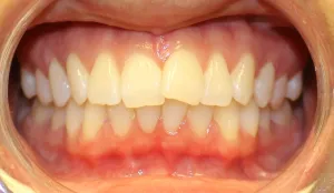 Before photo: Crowded and overlapped upper front teeth in Mento OH