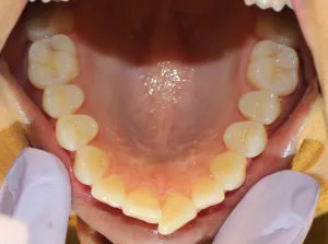 Before photo: Crowded and overlapped upper front teeth, looking up and inside the mouth in Mento OH