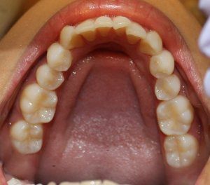 Before photo: Crowded and overlapped lower front teeth, looking down and inside the mouth in Mento OH