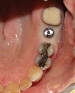 During Photo: Dental Implant placed (looking down into jaw) in Mento OH