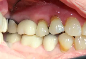 After photo (side view): Final tooth replacement with abutment crown on dental implant in Mento OH