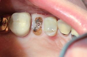 Before Photo: Worn and Fractured Teeth (looking down into jaw) in Mento OH
