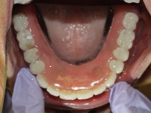 After Photo (inside the mouth view): Dentures snap onto supporting upper jaw Dental implants in Mento OH