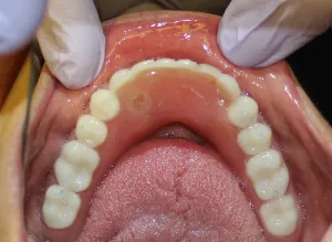 After Photo (inside the mouth view): Dentures snap onto supporting lower jaw Dental implants in Mento OH