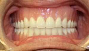 After Photo (front view): Patient with removable upper and lower dentures supported on Dental Implants in Mento OH