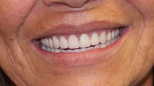 After Photo (front view): Patient smile showing new implant-supported dentures in Mento OH