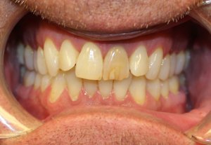 Before photo: Patient mouth with crowded and mis-shaped teeth in Mento OH