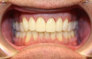 After photo: Patient mouth with crowded teeth restoration and whiter teeth in Mento OH