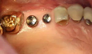 During Photo: Dental Implants placed (looking down into jaw) in Mento OH