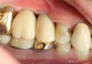 After photo (side view): Final teeth replacement with abutment crowns on dental implants in Mento OH