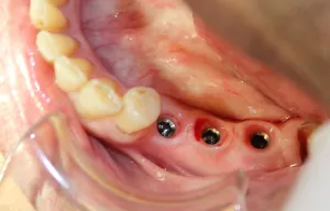 During Photo: Three Dental Implants placed (looking down into jaw) in Mento OH