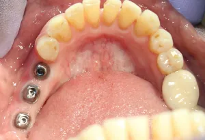 After photo: Abutments placed on 3 dental implants in Mento OH