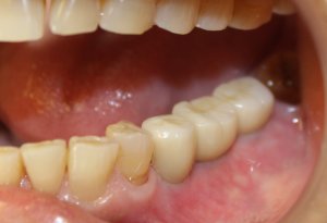 After photo (side view): Final teeth replacement with abutment crowns on dental implants in Mento OH