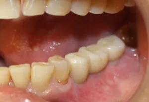 After photo (side view): Final teeth replacement with abutment crowns on dental implants in Mento OH