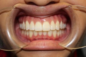 After photo: Showing straightened teeth and bite in upper and lower teeth in Mento OH