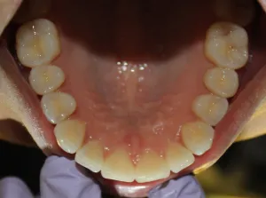 After photo: Showing straightened upper teeth and bite, looking up and inside the mouth in Mento OH