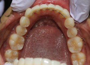 After photo: Showing straightened lower teeth and bite, looking down and inside the mouth in Mento OH