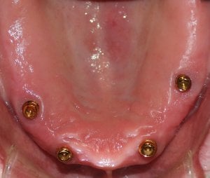 During Photo (inside the mouth view): Four Dental Implants placed in the upper jaw in Mento OH