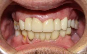 After photo: Patient mouth showing esthetic restorations with dental cowns in Mento OH
