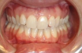 Before photo: Patient mouth exhibiting crowding and crossbite in Mento OH