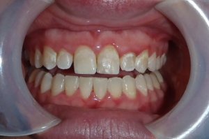 Before photo: Patient mouth with discolored and crowded teeth in Mento OH