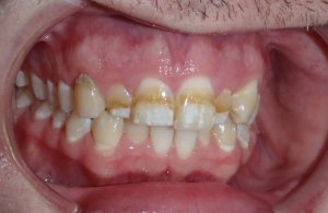 Before photo: Stained upper teeth in Mento OH