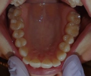 Before photo: Crowing in upper teeth in Mento OH