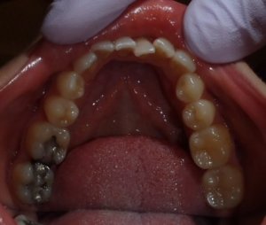 Before photo: Crossbite and crowding in lower teeth in Mento OH