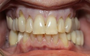 Before photo: damaged and worn teeth in Mento OH