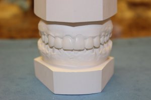 Photo of a upper and lower teeth dental model used to create aesthetic dental crowns in Mento OH