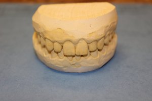 Photo of a dental model used to create aesthetic dental crowns in Mento OH