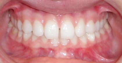 Before photo: Patient with tooth crowding and spacing issues in Mento OH