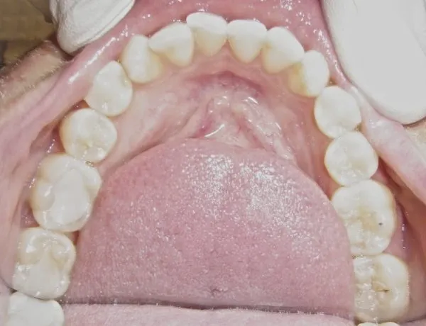 Before inside photo: Patient with crowding in lower jaw in Mento OH
