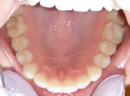 After inside photo: Patient with no gaps between upper jaw teeth in Mento OH